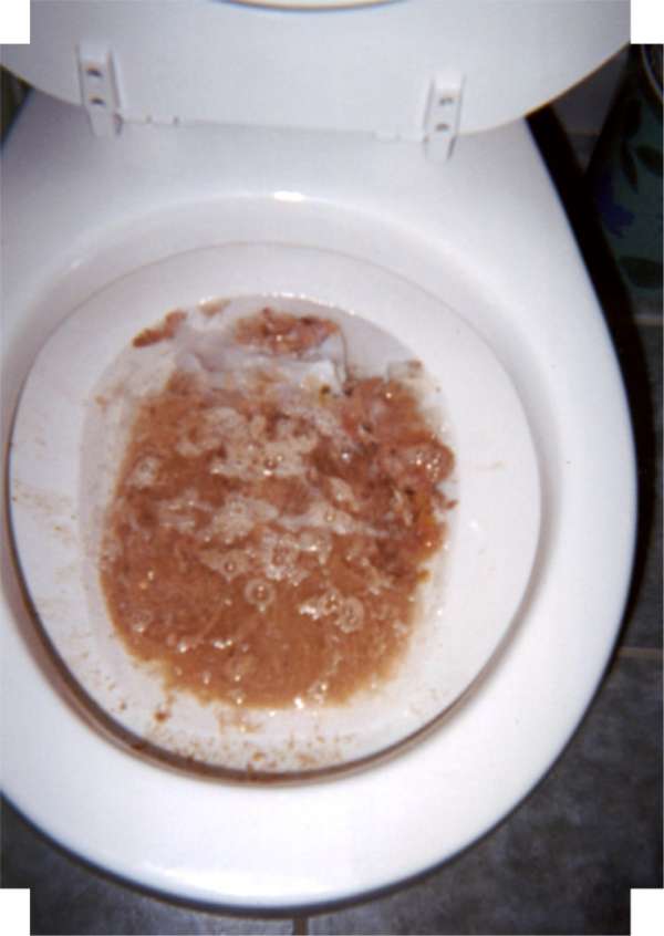 Bloody Vomit In Toilet Bloody Vomit In Toilet